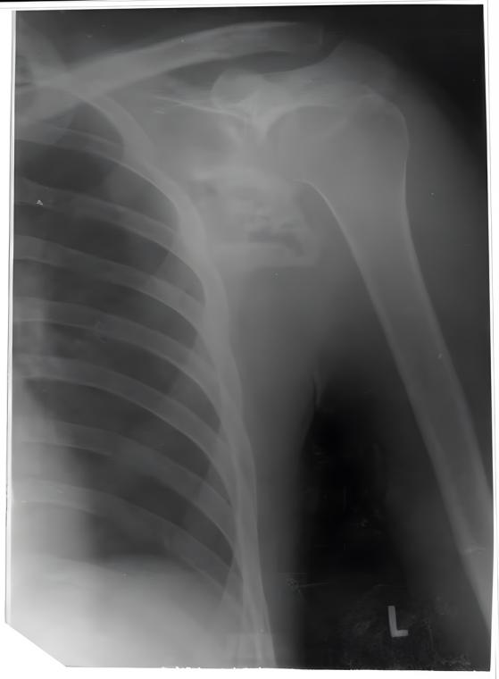 X-ray showing the gunshot wound of Heike’s paternal grandfather.